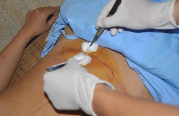 Kỹ thuật khâu vết mổ