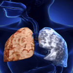 kỹ thuật chăm sóc bệnh nhân copd