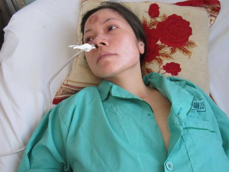 Kỹ thuật đặt sonde dạ dày – phương pháp phổ biến trong y học hiện nay